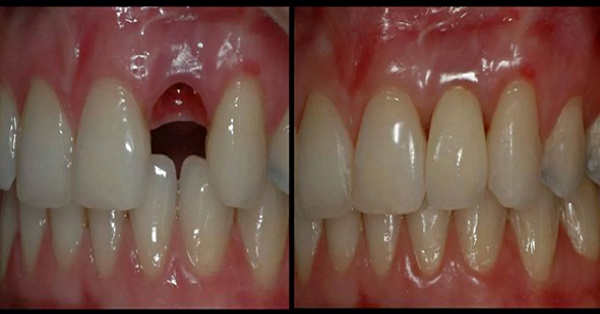 Виростити нові зуби за 9 тижнів. Нова революційна технологія