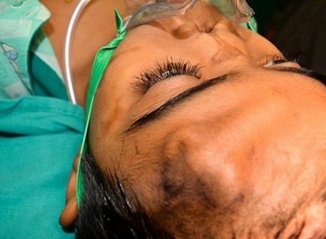 Медики виростили ніс на лобі дитини